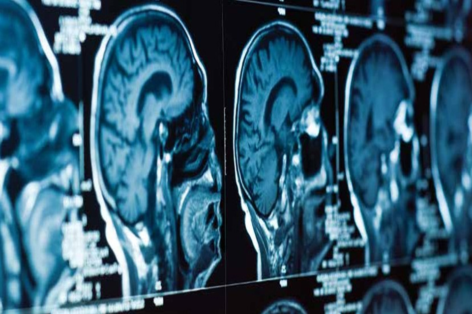 Brain scan