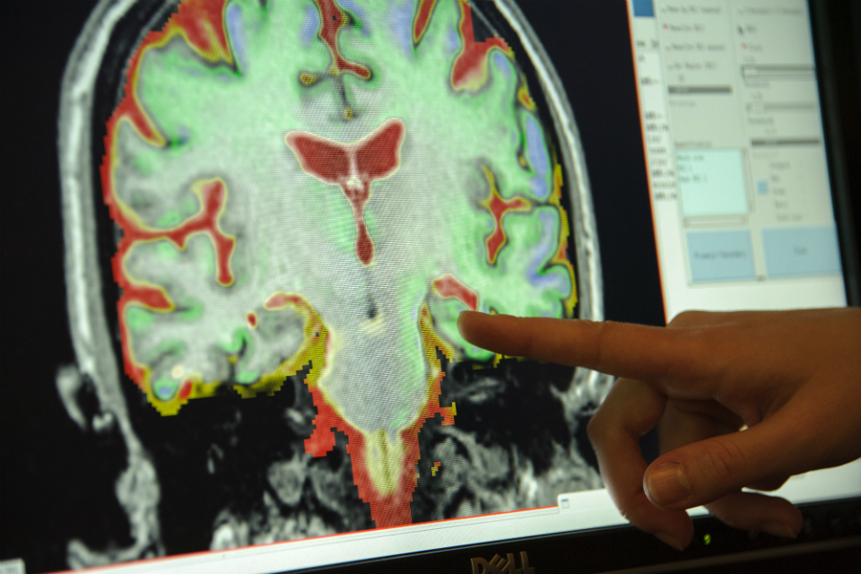 dementia research