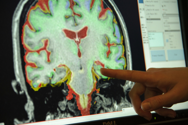 dementia research