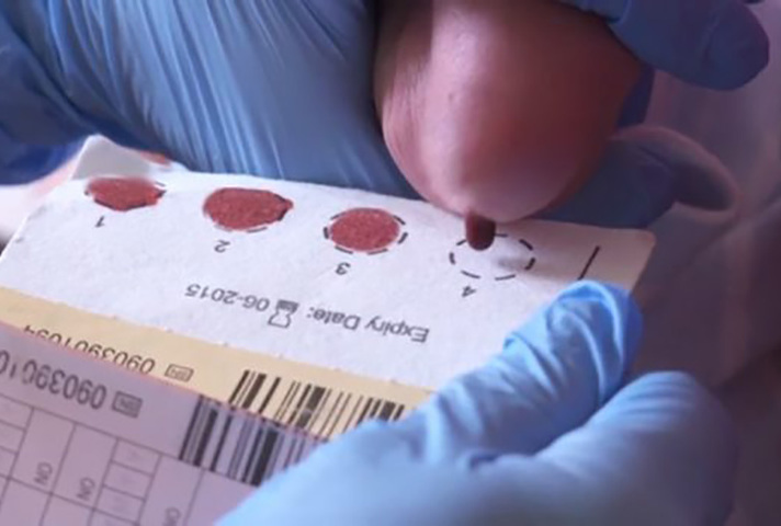 Blood spot sample being transferred to blood spot card