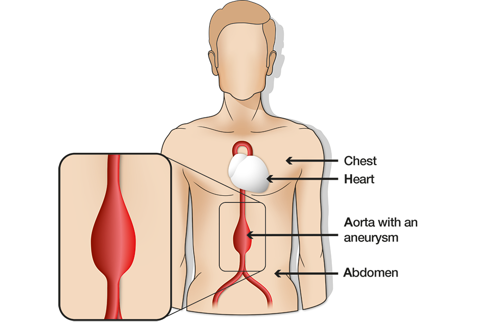 Os Resultados Do Seu Rastreio Tem Um Aneurisma Da Aorta Abdominal Aaa Grande Gov Uk