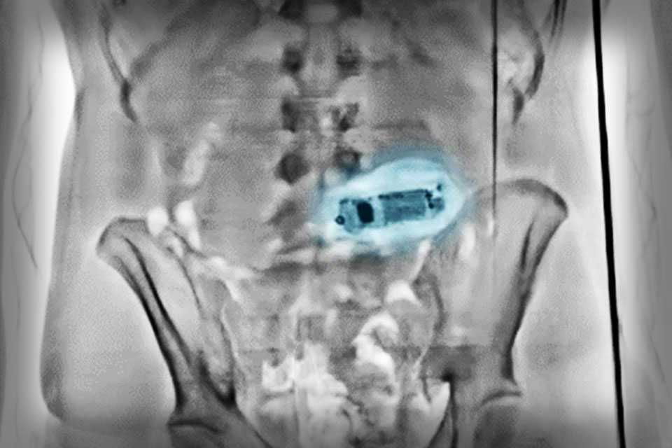x ray body scan