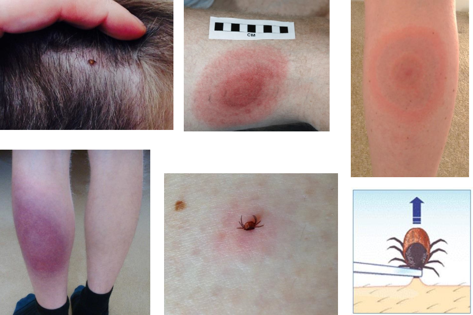 Lyme Disease Signs And Symptoms Gov Uk