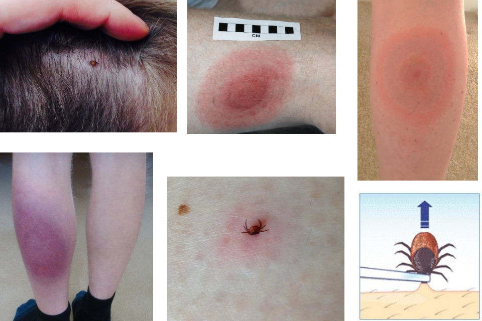 tick bite symptoms in adults