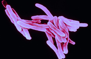 Tuberculosis