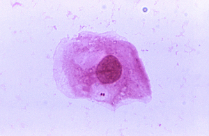 Neisseria meningitidis