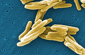 Tuberculosis