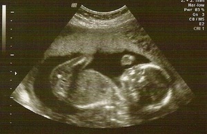 An ultrasound scan of a baby.