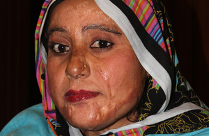 Nusrat, an acid attack survivor, who was helped by the Acid Survivors Foundation. Picture: DFID