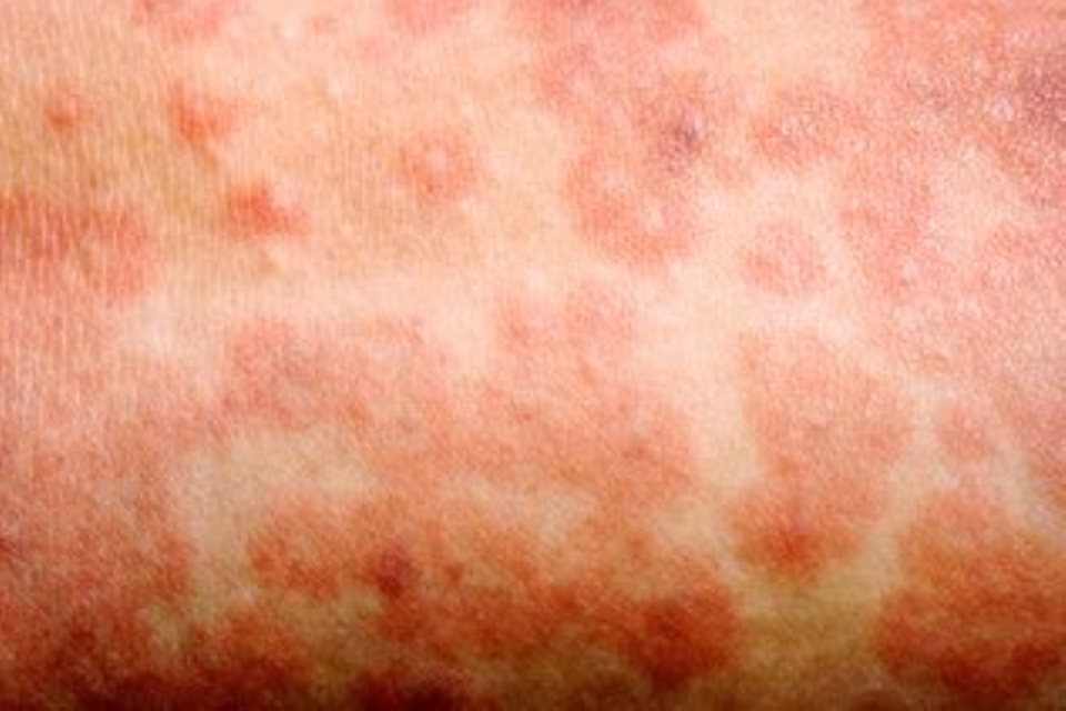 Measles outbreaks in Europe Easter travel advice GOV.UK