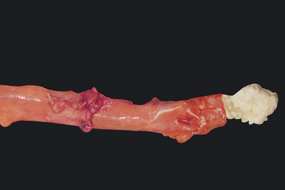 Clogged artery