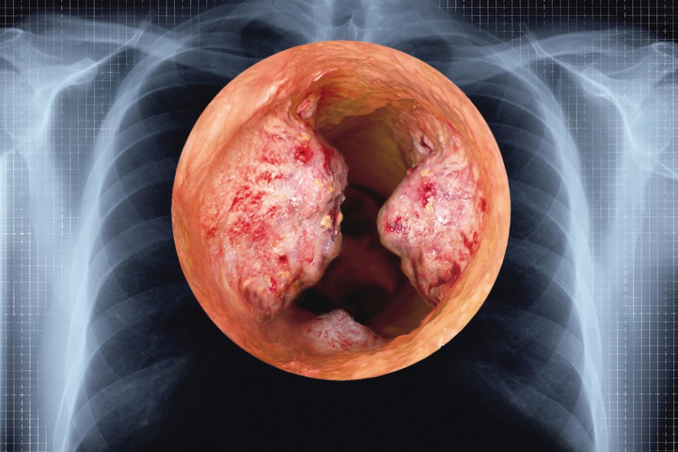 Lung tumour cross-section against ribcage x-ray
