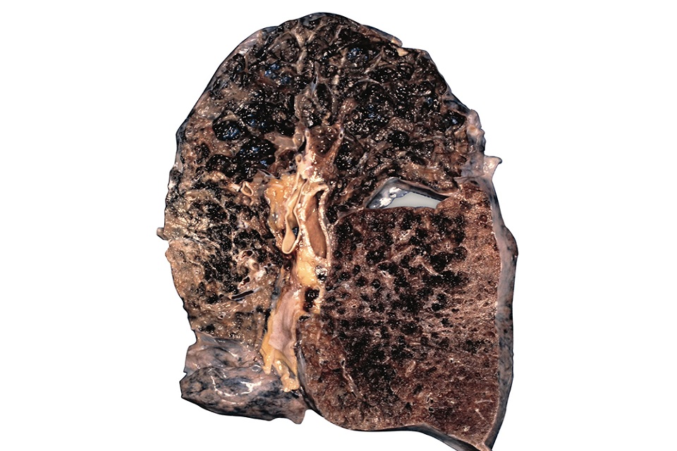 Lung of emphysema sufferer