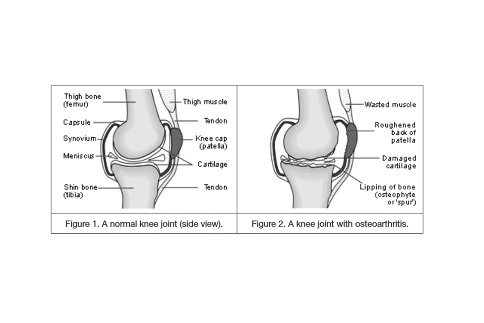 Рис. 1. Изображение коленного сустава в норме и рис. 2. Коленный сустав с остеоартритом.