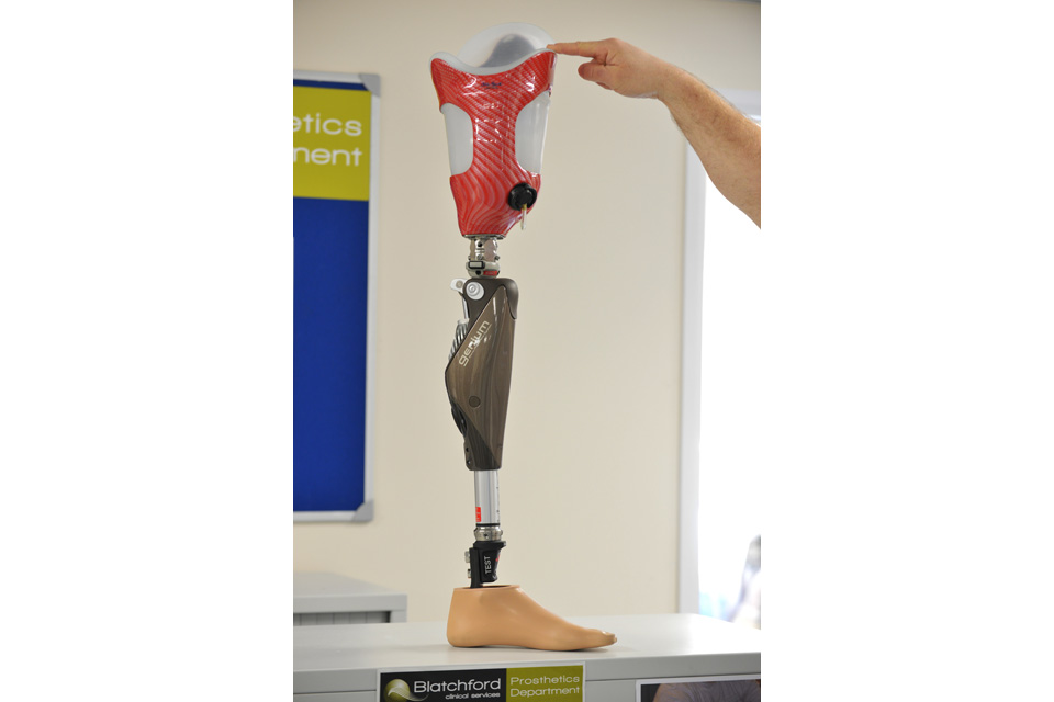 The Genium C-Leg® bionic prosthetic system
