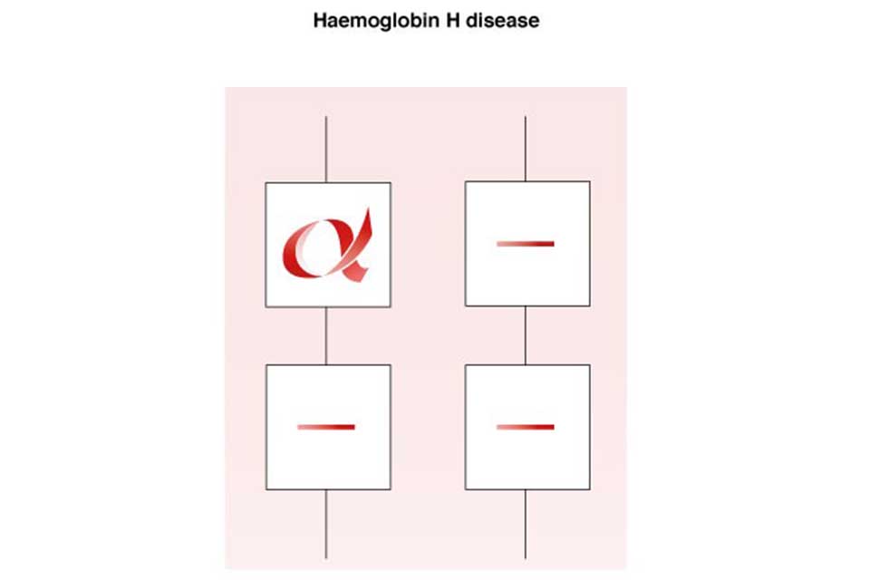 Haemoglobin H Disease