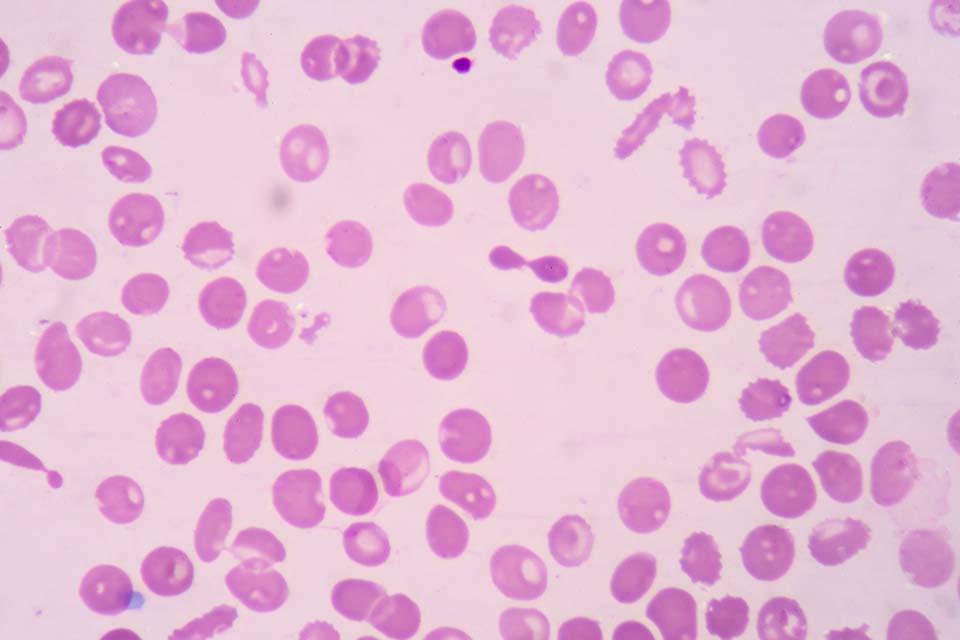 Thalassaemic red blood cells