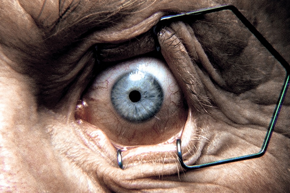 Staring eye prepared for medical procedure