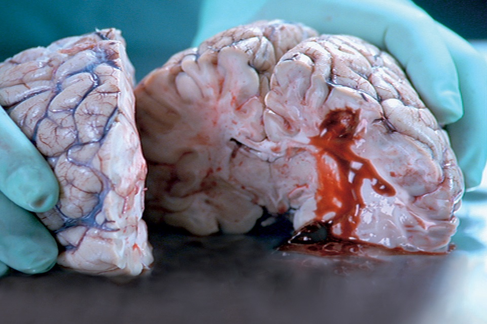 Dissected  brain of stroke victim