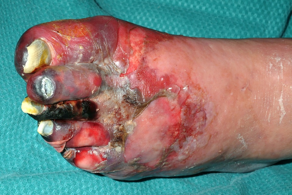 Foot with severe gangrene
