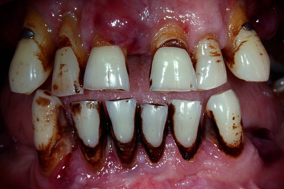 Stained teeth of smoker aged 50