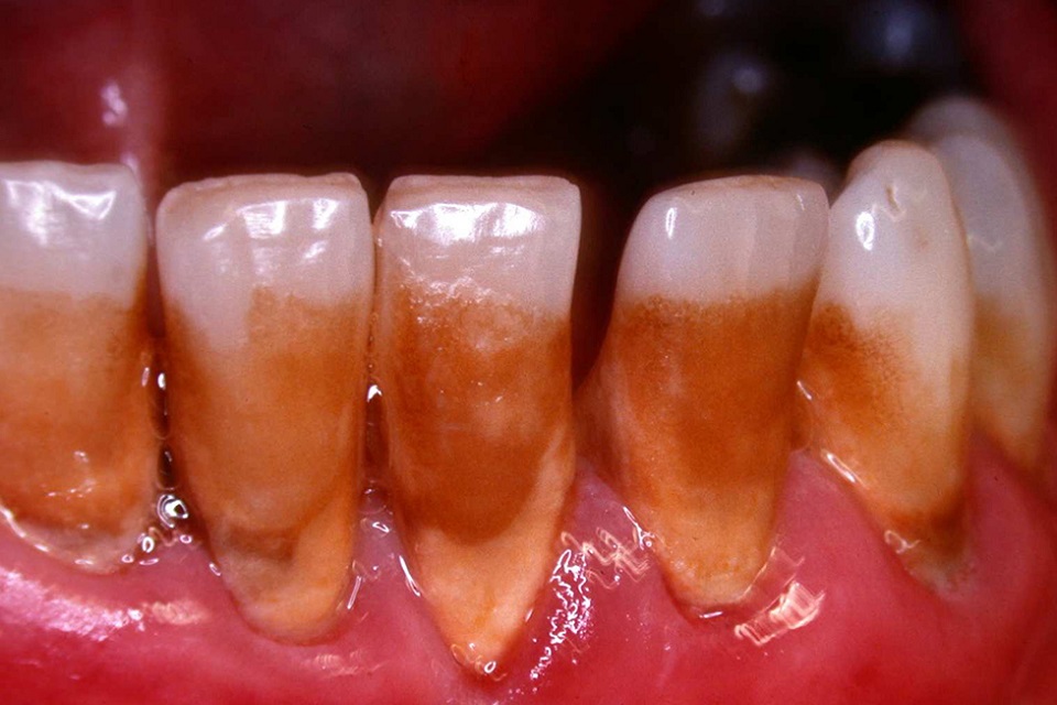 Stained teeth of smoker aged 45