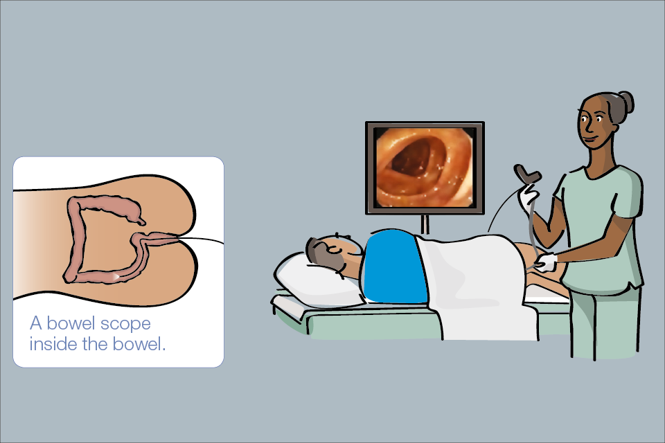 Illustration of man having bowel scope screening, with diagram of the bowel scope inside the bowel.
