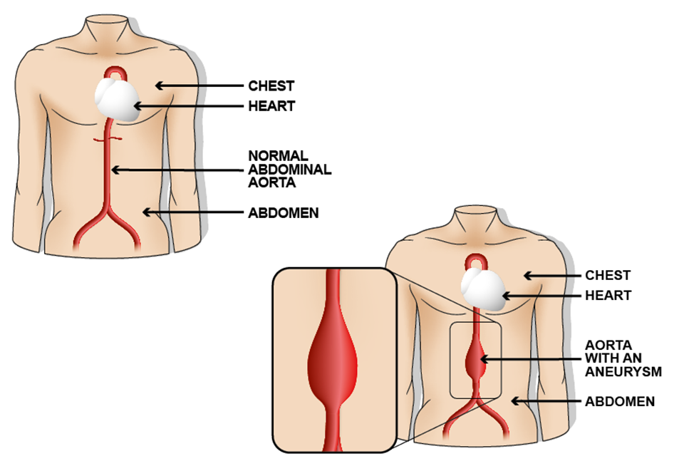 Drawing of a man's torso, showing chest, heart, normal abdominal aorta and abdomen next to another drawing of a man's torso, showing chest, heart, abdominal aorta with an aneurysm and abdomen