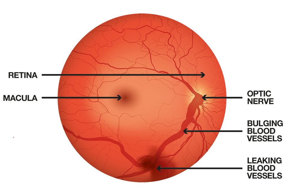 A digital photograph of a retina showing signs of damage from diabetic retinopathy
