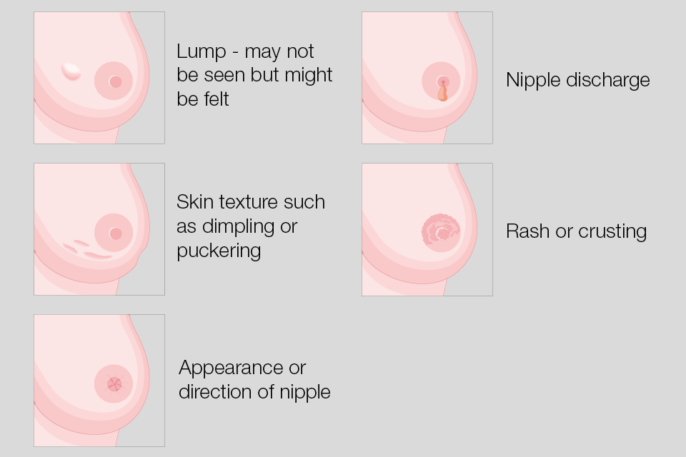 Images showing the main symptoms of breast cancer: a lump, changed skin texture, changed appearance or direction of nipple, nipple discharge, and a rash or crusting.