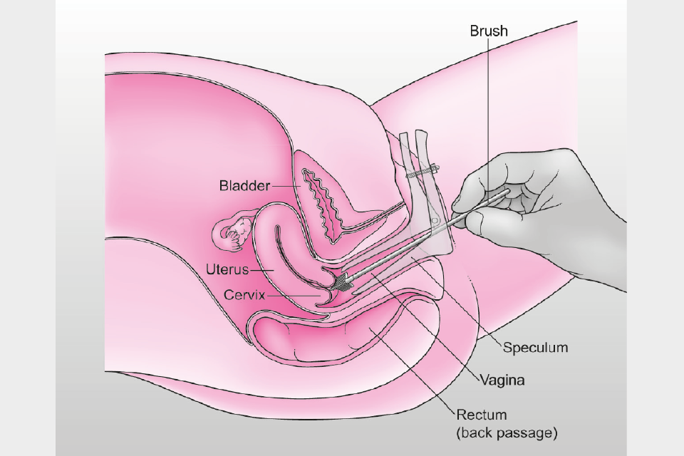 Side-on diagram showing how a cervical screening sample is taken, with the speculum and small soft brush inside the vagina.
