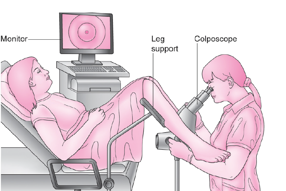 Illustration of a woman having a colposcopy. She is lying on a couch with her legs in supports. The colposcopist sits between her legs, looking at her cervix with a colposcope.