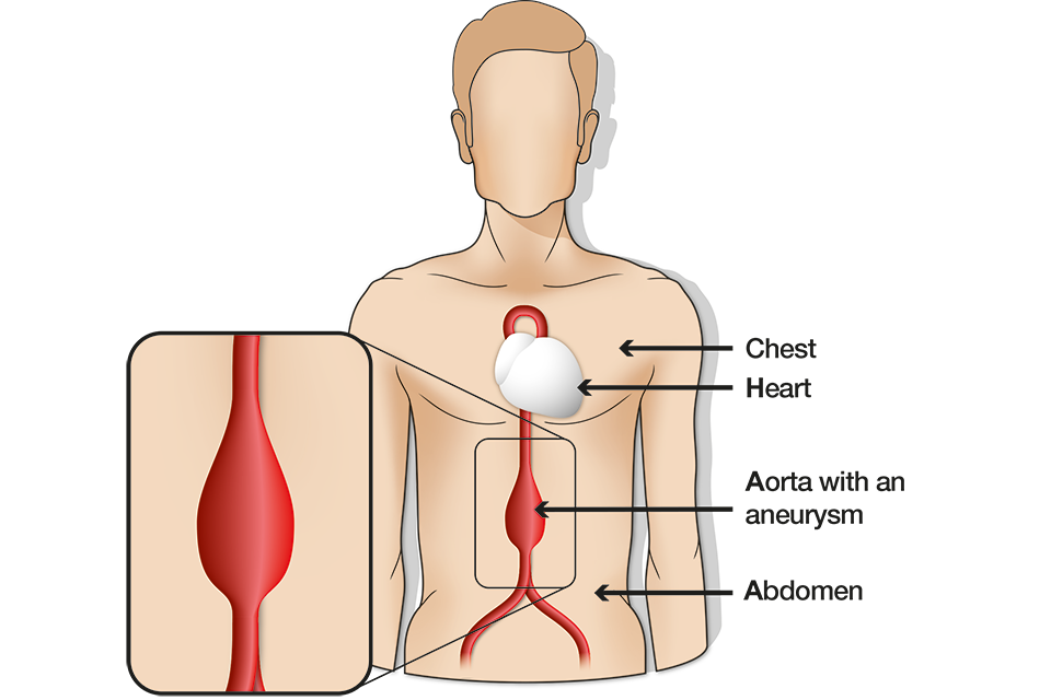 Diagram of a male torso showing the chest, heart, aorta with an aneurysm and abdomen.