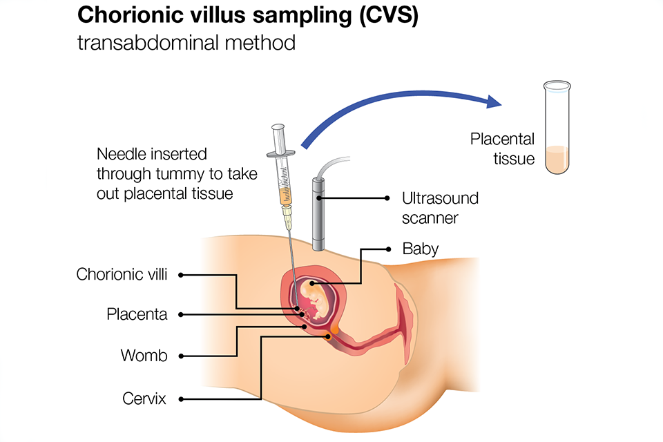 Illustration of chorionic villus sampling transabdominal procedure