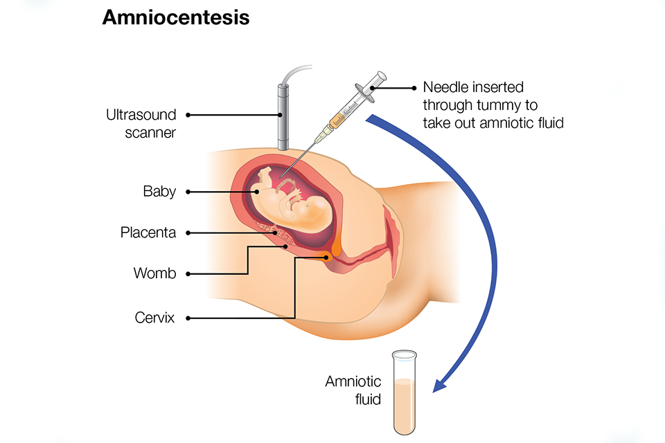 Illustration of amniocentesis procedure
