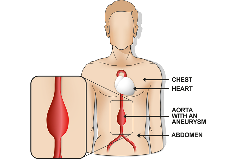 Illustration showing an aorta with an aneurysm