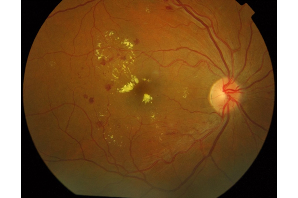 OCT image of retina showing high risk maculopathy