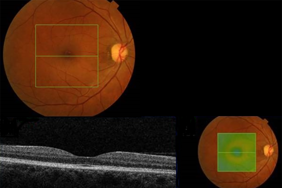 OCT retina image Example 1 R1M0 and OCT negative