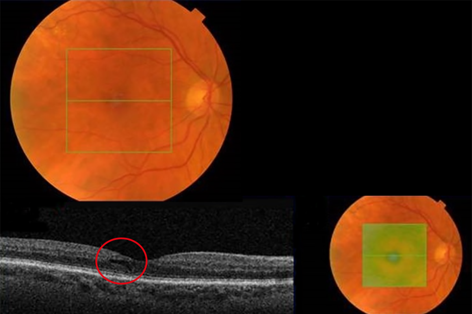 OCT retina images Example 3 R1M1 and OCT borderline
