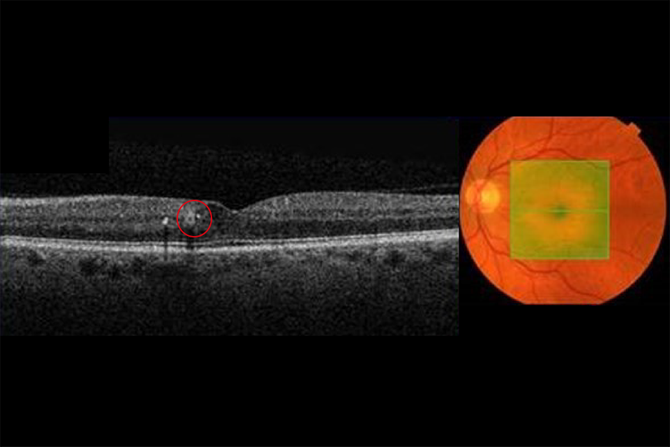 OCT retina images Example 5 R1M1 and OCT positive