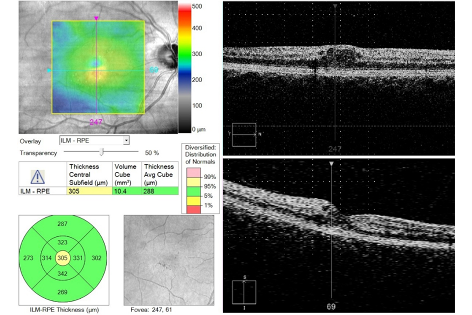 OCT retina images Example 6 R1M1 and OCT positive