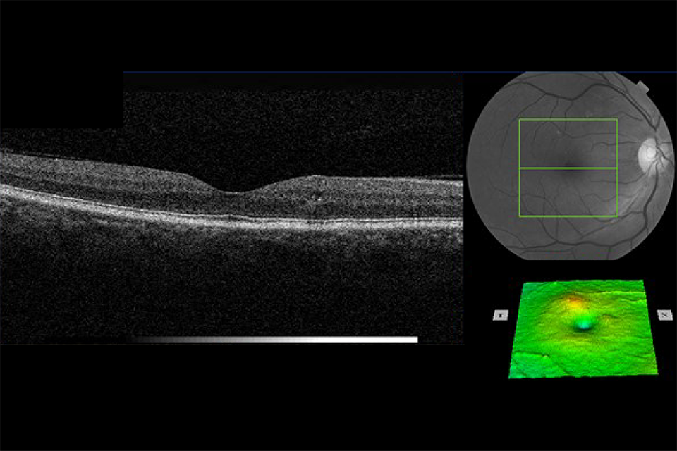 OCT retina images Example 7 R1M1 and OCT positive