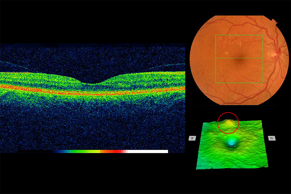 OCT retina images Example 8 R1M1 and OCT positive