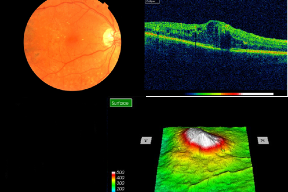 OCT images of retina Example 9 R1M1 and OCT positive