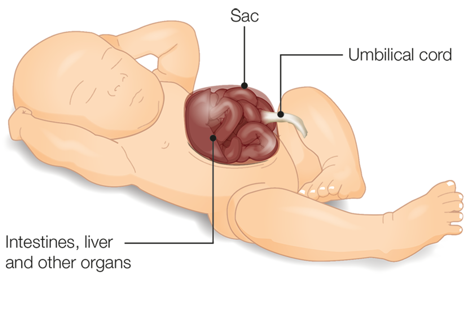 Illustration of baby with exomphalos showing intestines, liver and other organs developed outside the abdomen