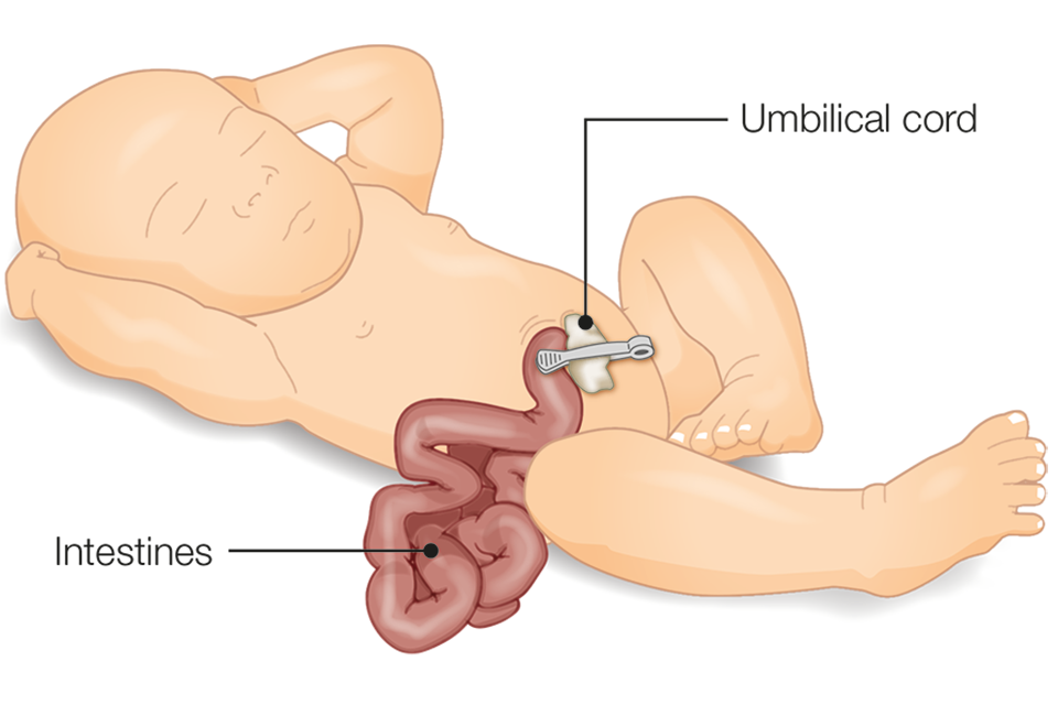 Illustration of a baby with gastroschisis showing intestine developed outside the body