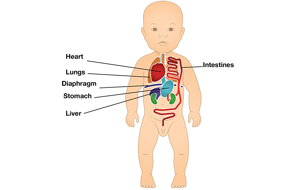 An illustration of a baby with its organs in unusual places due to a congenital diaphragmatic hernia.