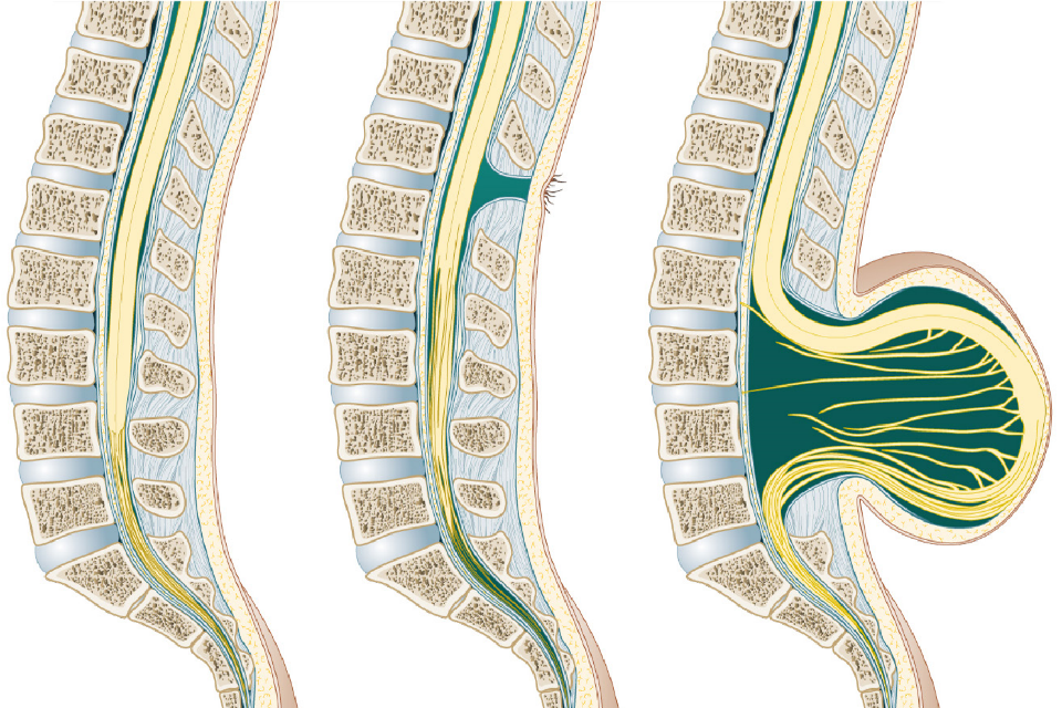 Three illustrations showing a fully formed spine, a spine with closed spina bifida and a spine with open spina bifida with sac coming out.