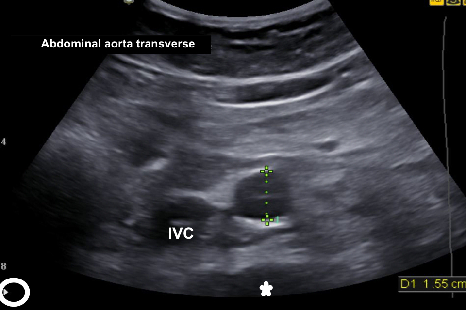 A transverse image of the aorta with acceptable depth and gain settings and visible key landmarks such as the inferior vena cava (IVC) and anterior border of the lumbar spine.