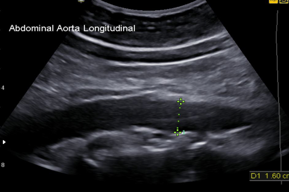 A longitudinal image of the aorta showing the correct line of measurement has been used.